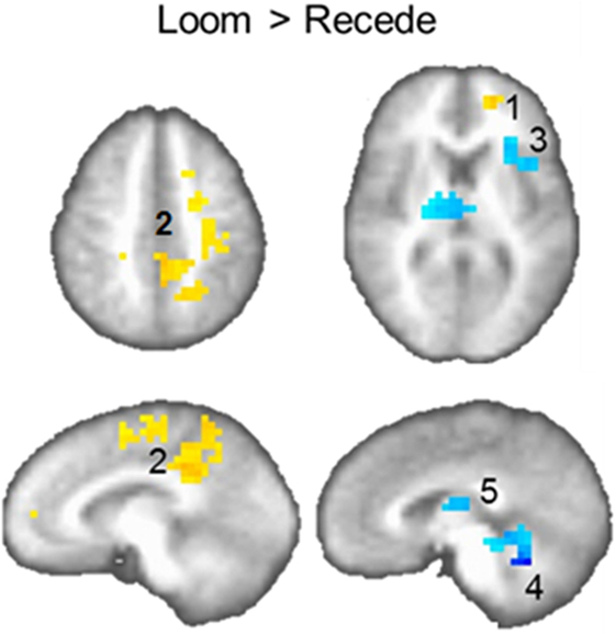 Figure 2 - Brain activation for the Loom versus the Recede condition.